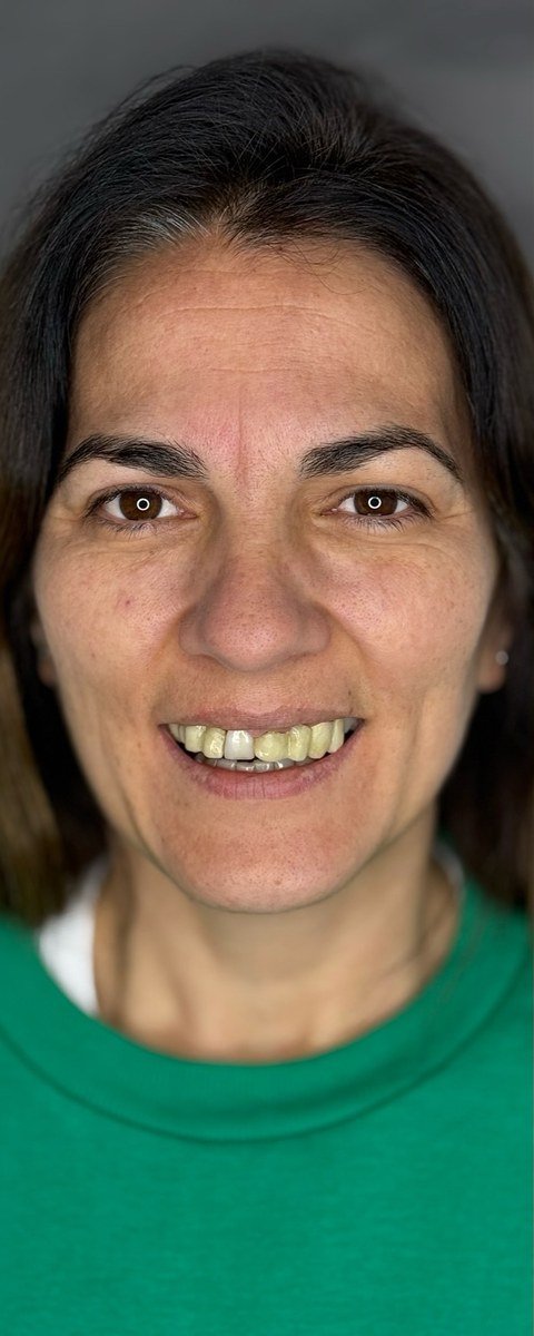 Antes de rehabilitación estética y funcional — Franca Dental
