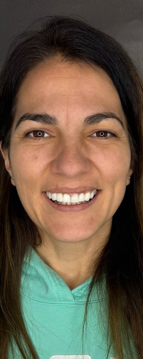 Después de rehabilitación estética y funcional — Franca Dental