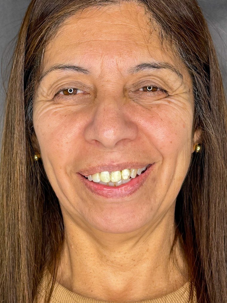 Antes de rehabilitación estética — Franca Dental