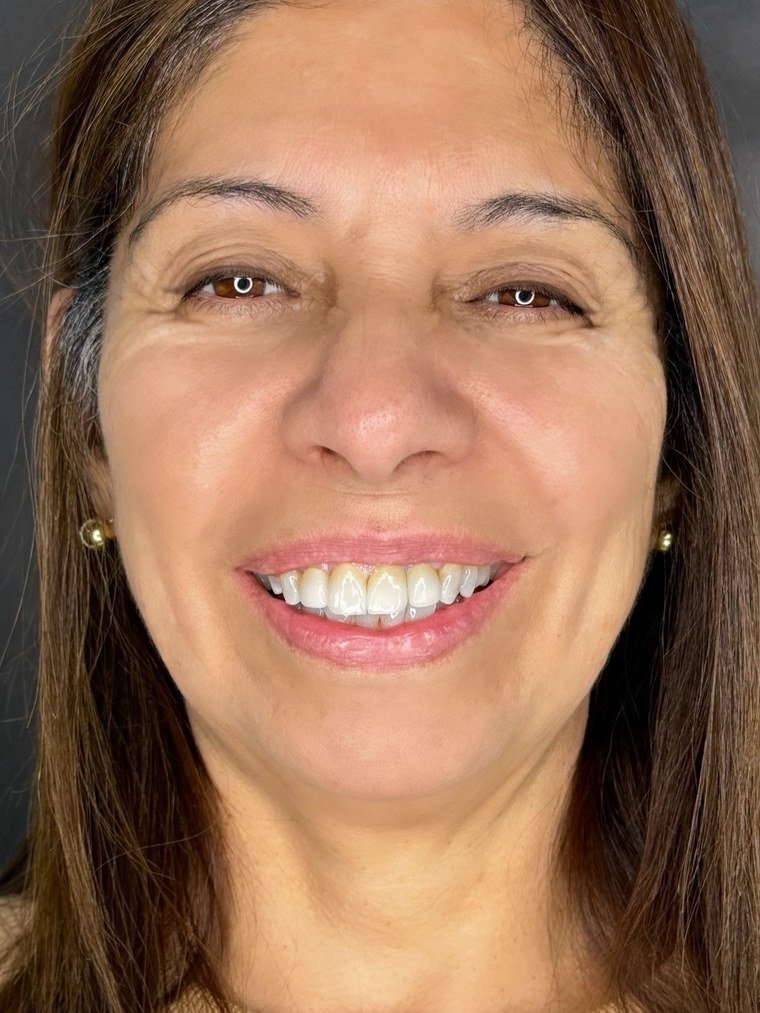 Después de rehabilitación estética — Franca Dental